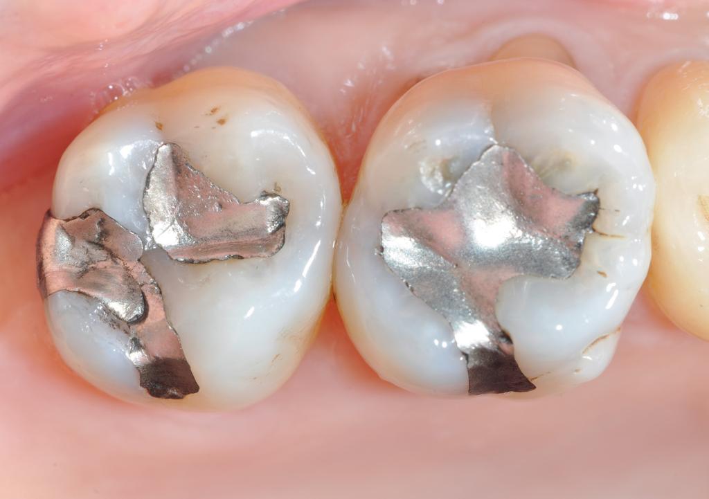 Ceramic Overlays Amalgam replacement ESTHETICS Case by Dr. Giuseppe Marchetti During a routine check-up insufficient amalgam restorations and secondary caries were diagnosed.