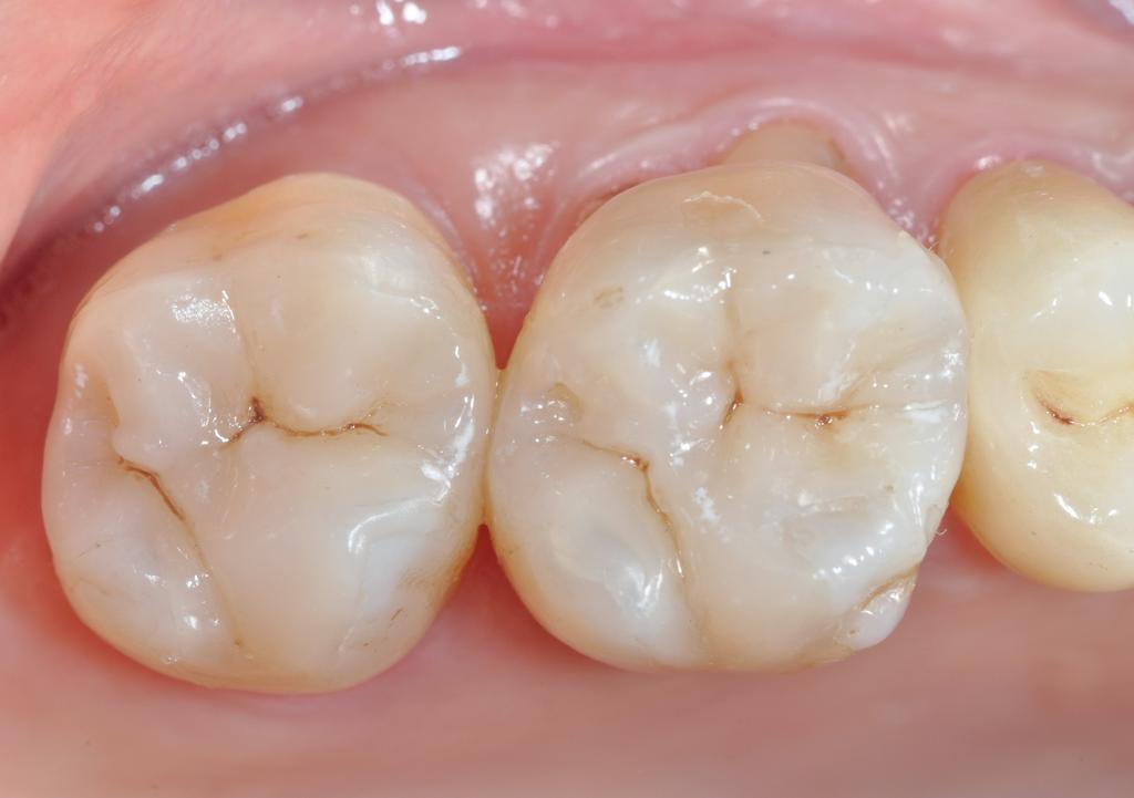 Impression Due to Material the fact that is s he presented newest ceramic generation restorations on the antagonist arch, the ceramic overlays were the treatment of choice.