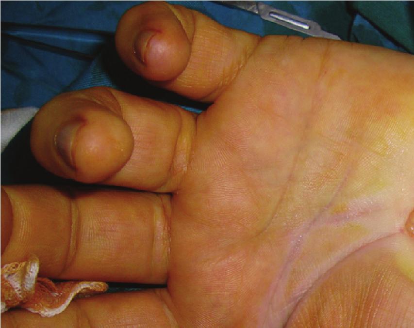 Conclusion Although rare, a bifid median nerve should be kept in mind in cases with unilateral or severe carpal tunnel syndrome, failed carpal tunnel release, and early postoperative recurrence.