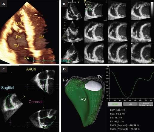 3D echo modes of a 3D data set of the right ventricle (RV) obtained from the RV-focused apical four-chamber view using full-volume multi-beat acquisition A.