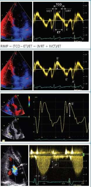 excursion, peak S wave velocity of the lateral tricuspid annulus by tissue Doppler imaging [TDI], and