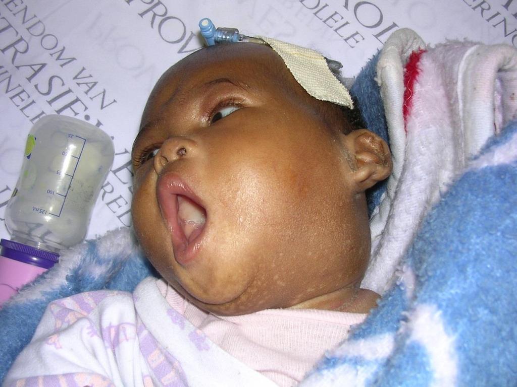 Complications of peripheral LN-TB Draining abscess formation and scarring Lesions can infiltrate bone and nerves and cause compression of airways 4-month-old baby girl