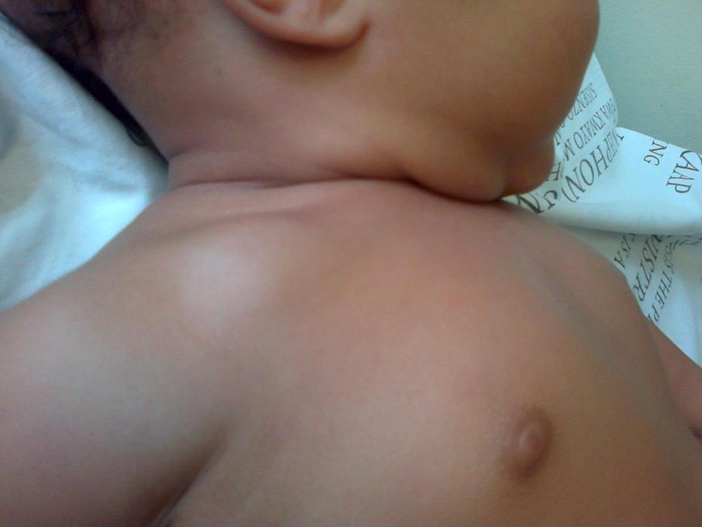 Case 5-month-old boy, presented with swelling right suprclavicular area not responding to antibiotics Mom (a nurse), no known TB contact.
