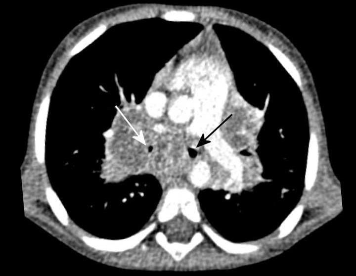 Axial CT scan post contrast demonstrates right hilar and subcarinal lymphadenopathy resulting in severe circumferential compression of