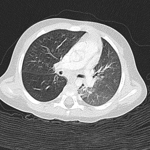 Axial CT scan on lung windows demonstrates air-trapping of the right
