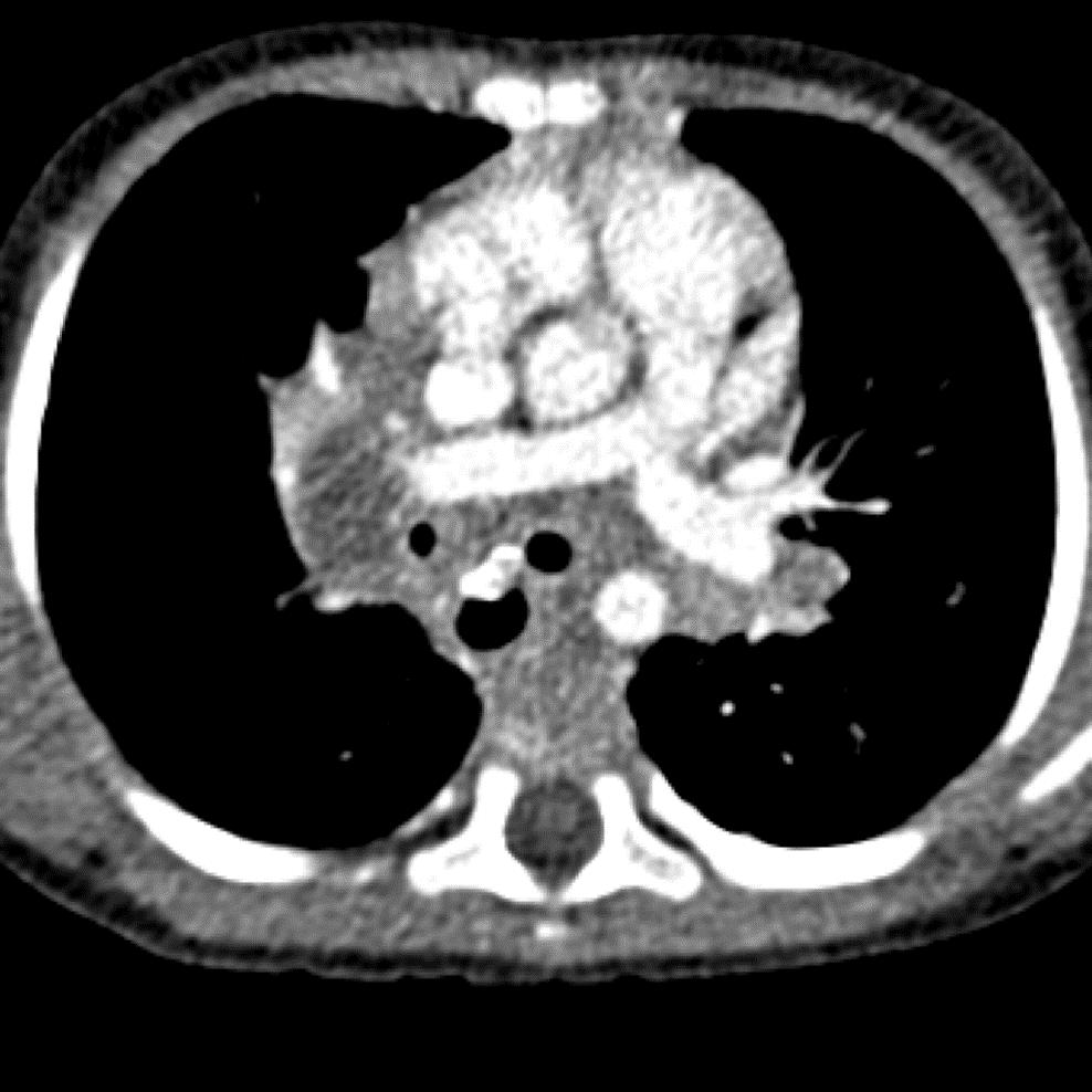 Figure 1 a and b: Axial CT scans in a child with BOF involving the left main bronchus Contrast enhanced axial CT immediately caudal to the carina demonstrates