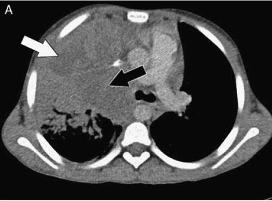 Postcontrast CT scan of the lungs demonstrating central areas of low density (arrows) within an area of airspace consolidation.