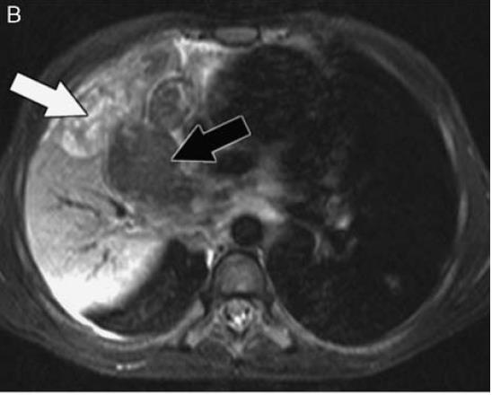 STIR MRI demonstrates that one area of CT low density demonstrates high signal (white arrow) intensity,