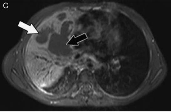 Postgadolinium T1-weighted MRI demonstrates that the areas of CT low
