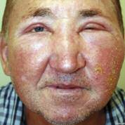 Case 3 Red and Itchy Face A 52-year-old male develops a swollen, red, and itchy face shortly after applying a new face cream 2. What is the significance? 3. What is the treatment? 1.