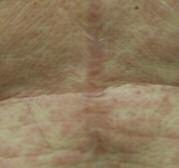 Acute Eruption of a Widespread Rash A 38-year-old male develops blanchable erythematous macules and papules on widespread areas of the torso and extremities.
