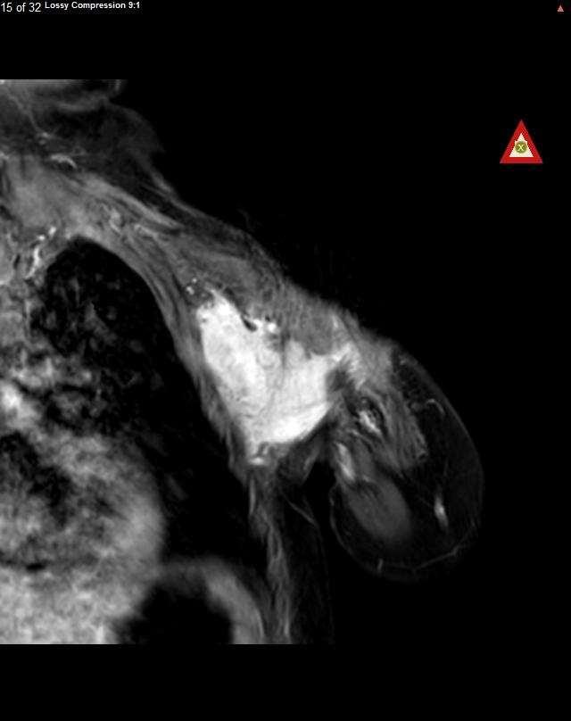 Case 5: 2 yo with SQSTM1-NTRK1 IFS (1 of 2) 2yo girl with infantile fibrosarcoma 3 cycles of