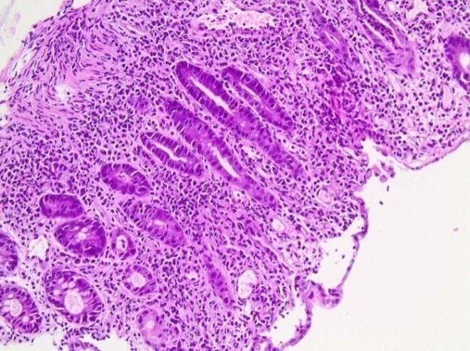 Results Histological characteristics Cryptitis usually