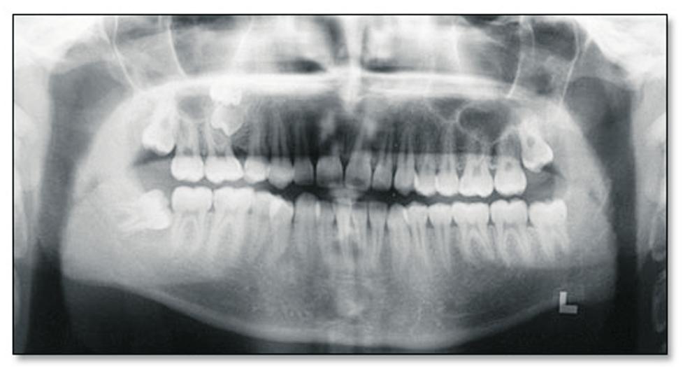 Figure 1. Panoramic radiograph showing a totally impacted deciduous maxillary right molar and impacted maxillary second premolar. Figure 2.