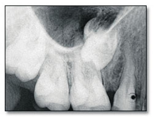 maxillary right second premolar and an impacted deciduous molar embedded within bone close to the inferior wall of the maxillary sinus (Figure 4).