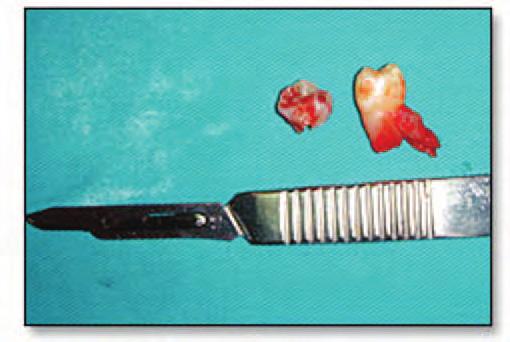 An orthodontic eyelet with gold chain was bonded to the premolar at the time of surgery.