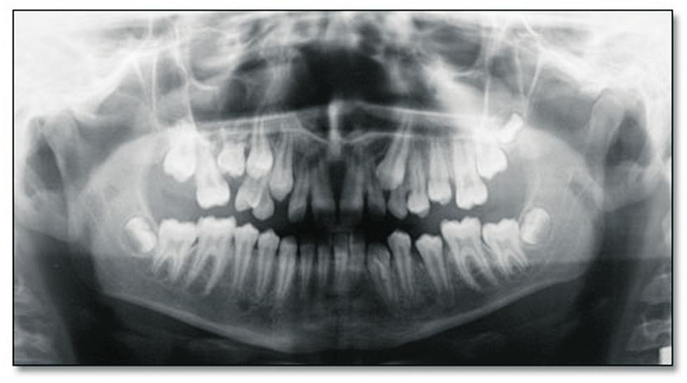 Figure 4. Panoramic radiograph showing a totally impacted deciduous maxillary right molar. Figure 5. Periapical radiograph of the totally impacted deciduous tooth.
