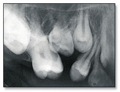 submersion. 2 In the reported cases both of the impacted teeth were ankylosed.