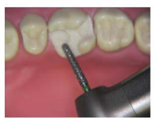 moveable bridges for angulation difficulties o Coping bridges for poor prognosis abutments Minimising failure in fixed prosthodontics and aesthetic dentistry Mechanical and biologic factors in
