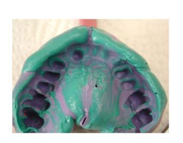 teeth Be able to undertake successful adhesive bridge techniques Understand advanced bridge techniques including large span, coping and fixed moveable bridges Appreciate how to minimise complications