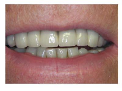 of the role of direct composite, onlays and overdentures in the treatment of tooth surface loss An understanding of the role of aesthetic dentures in