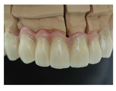 translucency, surface texture, dentine shades and tooth form to the laboratory Understand the role of gingival porcelains in compromised aesthetic cases Practical experience of aesthetic assessment