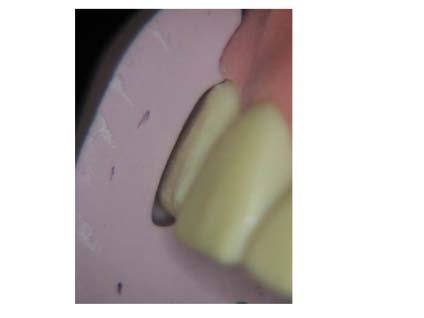 (the key to success) Porcelain veneers o From no prep to full coverage o Preparation guidelines, temporisation and cementation o Use of prep through guides and