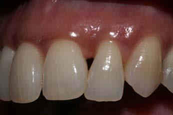 undersized teeth Treatment of peg laterals Cavity design including the infinity edge margin Anatomic David Clark
