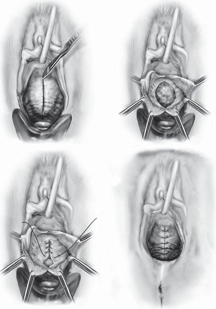 vaginal rejuvenation and cosmetic vaginal surgery Figure 104.8 Anterior repair drawings. Source : Courtesy of Robert D Moore and John R Miklos.