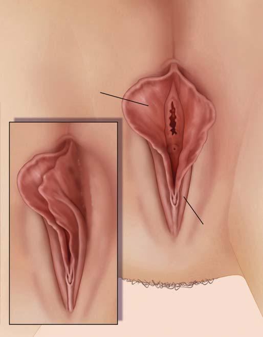 Source: Courtesy of Robert D Moore and John R Miklos. at the time of labial surgery leaves a very unnatural appearance and can make the clitoral area actually appear larger ( Fig. 104.16 ).