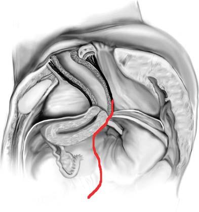 6 Uterine suspension with mesh: ( A ) lateral view of pelvis depicting