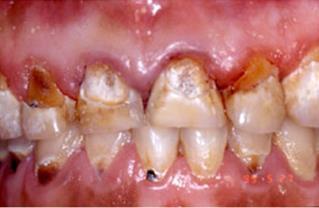 Prevalence 6 Dental caries is the most common chronic disease of childhood 5 times