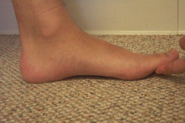 Hallux Range of Motion On Weight Bearing Place patient in