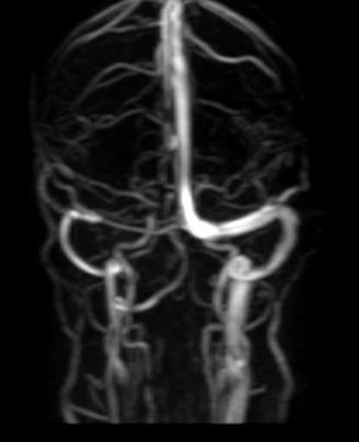 Superior sagittal Sinus thrombosis in combination with other sinus thrombosis is the highest percentage of occurrence observed followed by transverse Sinus Thrombosis, Straight sinus, sigmoid Sinus