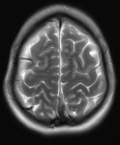 SWELLING OF THE CORTICAL VEINS. DOI: 10.