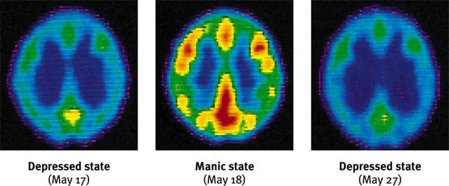 PET scans --brain energy consumption Courtesy of Lewis