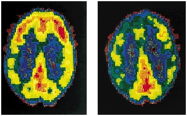 PET scan of 41 murderers -reduced activity in the frontal lobes -repeat offenders had 11% less frontal lobe