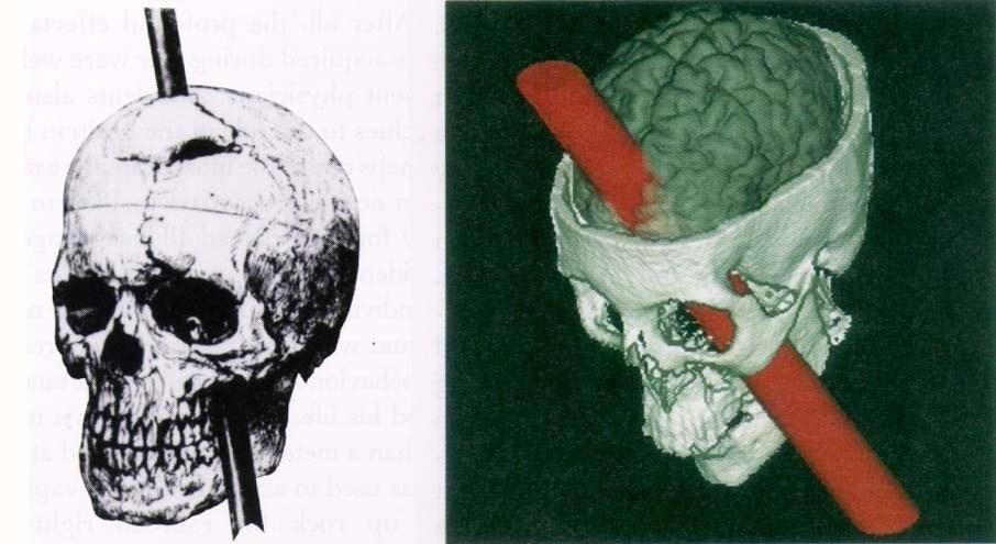 Traumatic Brain Injury Phineas Gage (1823-1861, accident in 1848)