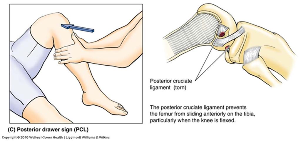 common PCL injury is