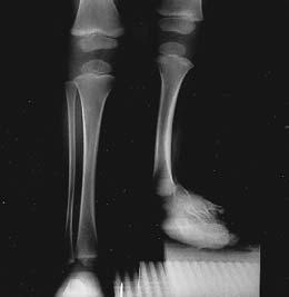 61 soft-tissue release (cases 13, 17 and 21), tendon release and lengthening(s) (cases 17, 18, 20 and 22), wedge osteotomy (case 14), or an Ilizarov foot extension (case 17).
