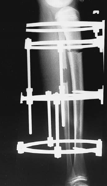 Figure 2c AP radiograph with an Ilizarov apparatus showing the proximal corticotomy sites.