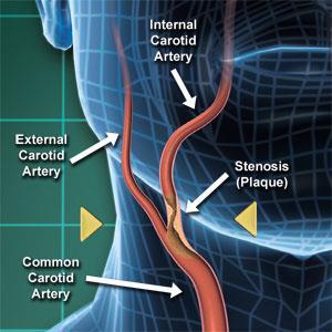 surgery compared to stenting The culprit Plaque buildup - atherosclerosis Carotid bifurcation most often affected Can extend into the proximal ICA (internal carotid