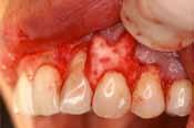 recession of soft tissue; crowns 12