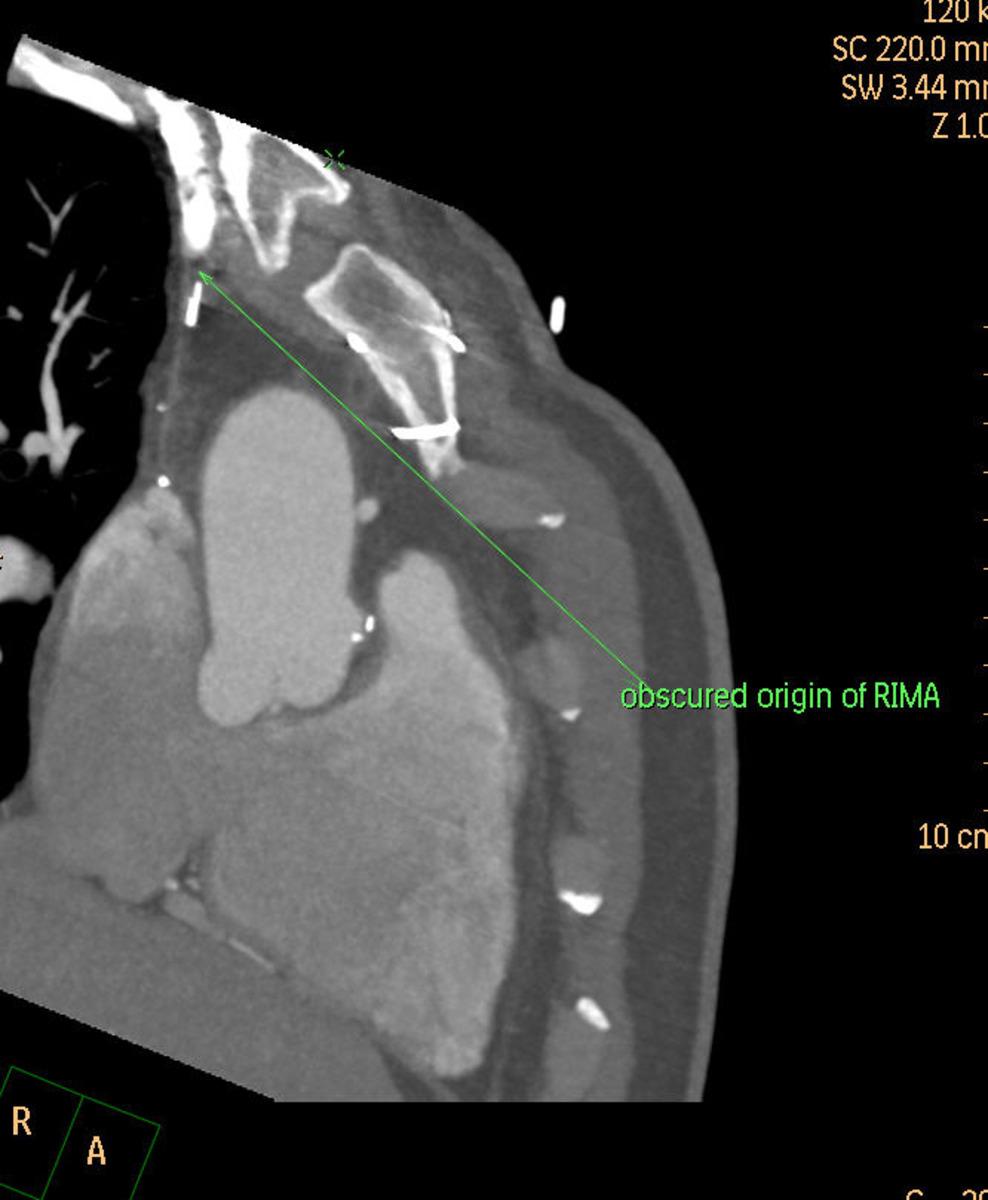 Fig. 3: Obscured RIMA from contrast