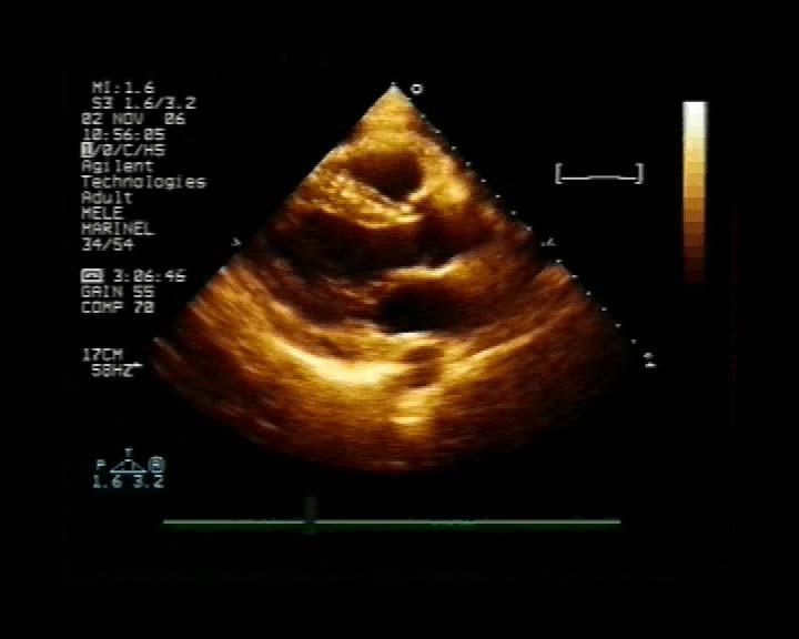 Transthoracal Echocardiography Pericardial effusion (6mm behind the LV posterior wall) with
