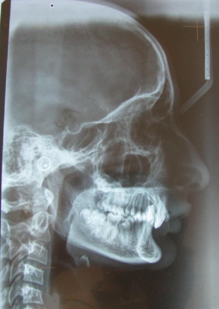 INFLUENCES ON JAW ORIENTATION : Bjork s implant studies show that rotation of the maxilla occurs during growth and although the internal rotation of the maxillary core usually is concealed by surface