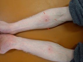 Effects of Acupuncture on Control of Pruritus Associated with Atopic Dermatitis and 3) upon removing the needles (Fig. 2).