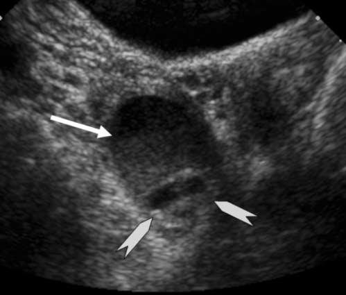 Endometrioma With Calcification Simulating a Dermoid Pelvic sonography depicted a normal uterus and normal left ovary. In the right adnexa, there was a 4 3 3.