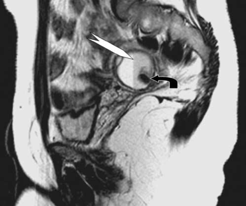 2 Thirty-five percent of endometriomas in their series showed hyperechoic wall foci, Figure 2.