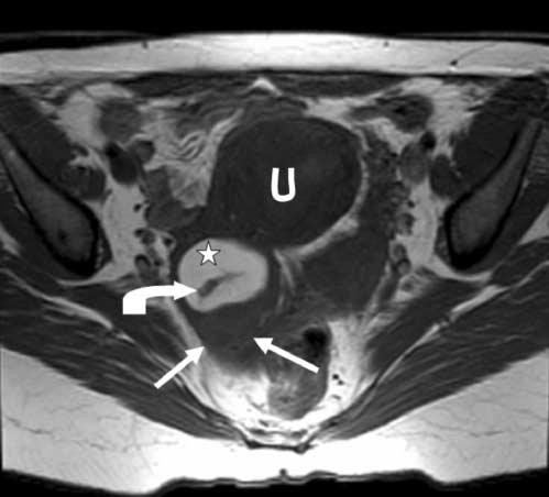 The focus with low signal intensity (curved arrow) is due to a calcification. U indicates uterus.